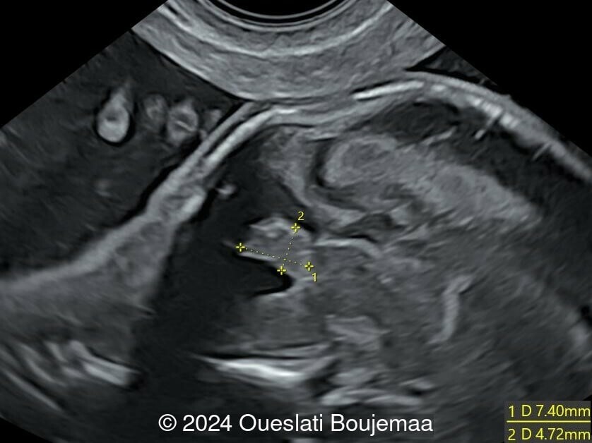 18 weeks gestation
