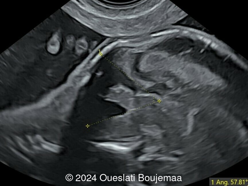 18 weeks gestation