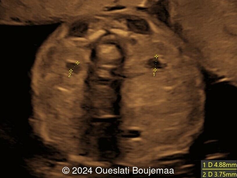 23 weeks gestation