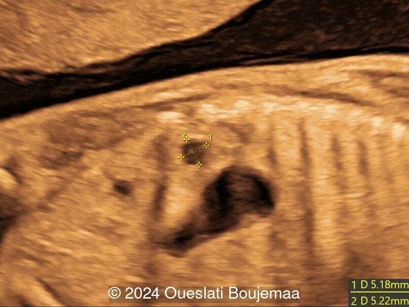 23 weeks gestation