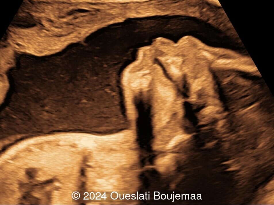 23 weeks gestation