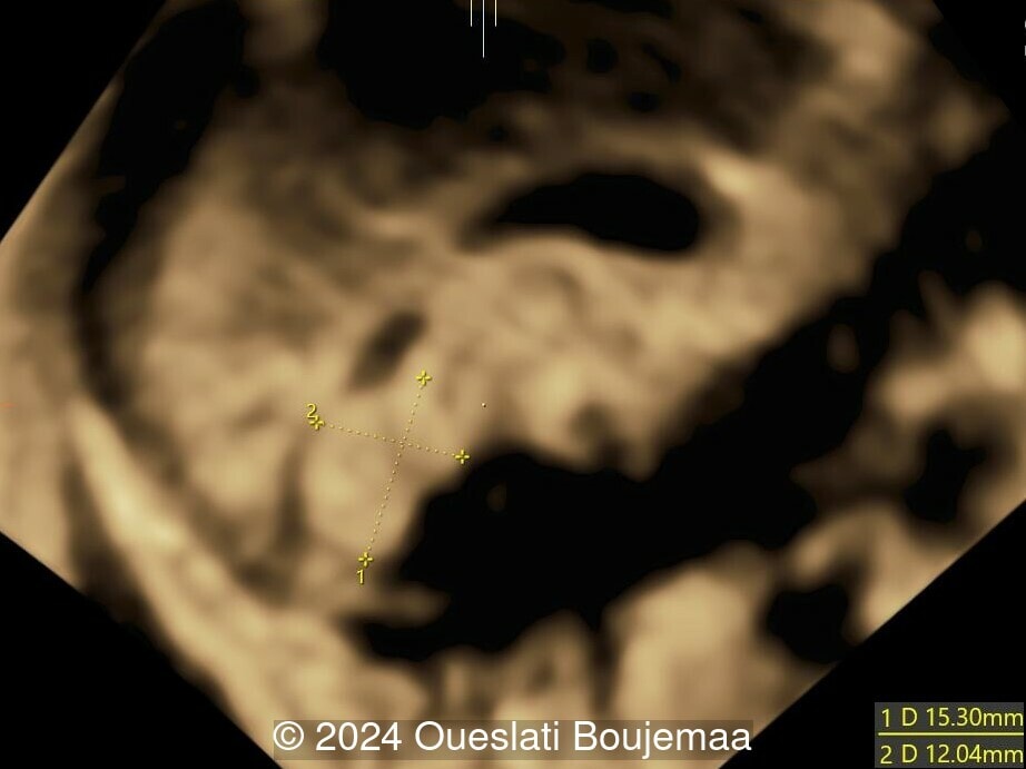 23 weeks gestation