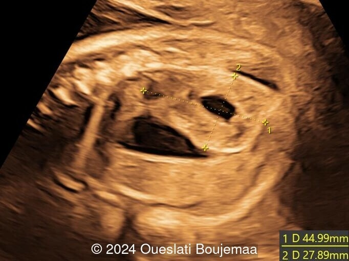 30 weeks gestation