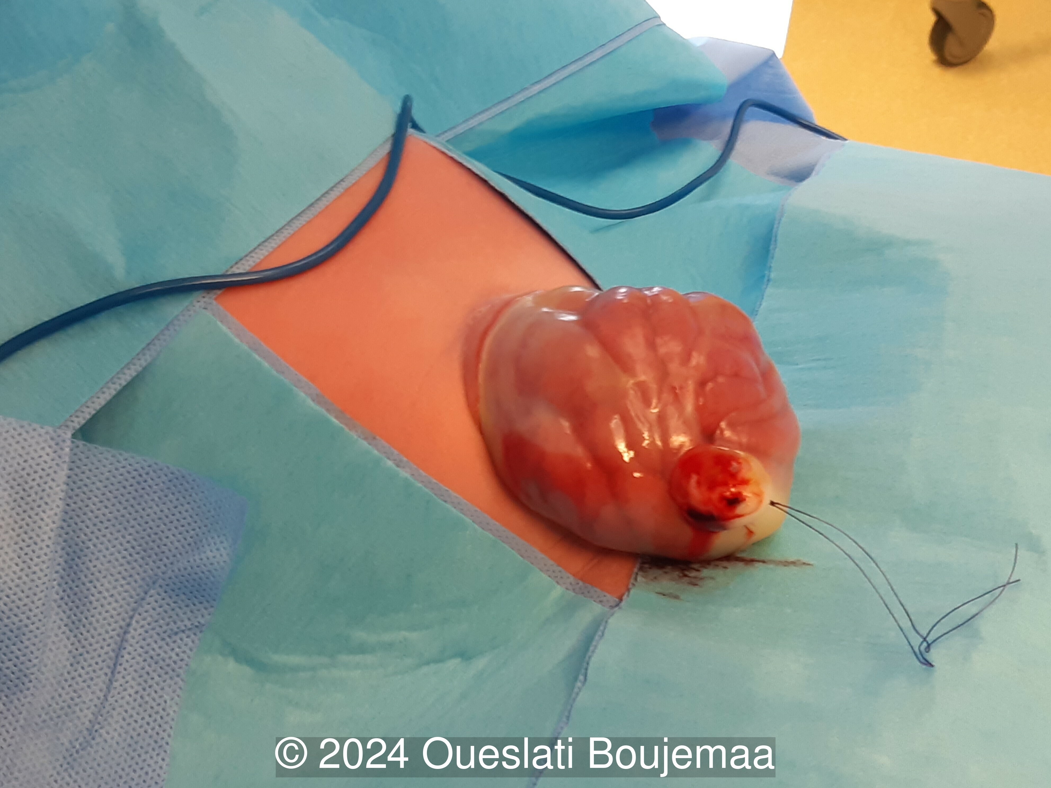 Postnatal image of neonate with omphalocele. 