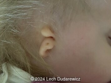 Dysplastic appearance of the right ear