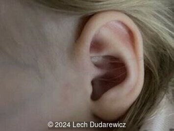 Normal left ear