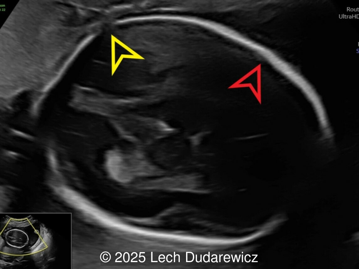 Transverse image demonstrating marked widened sagittal sutures and a closed coronal suture