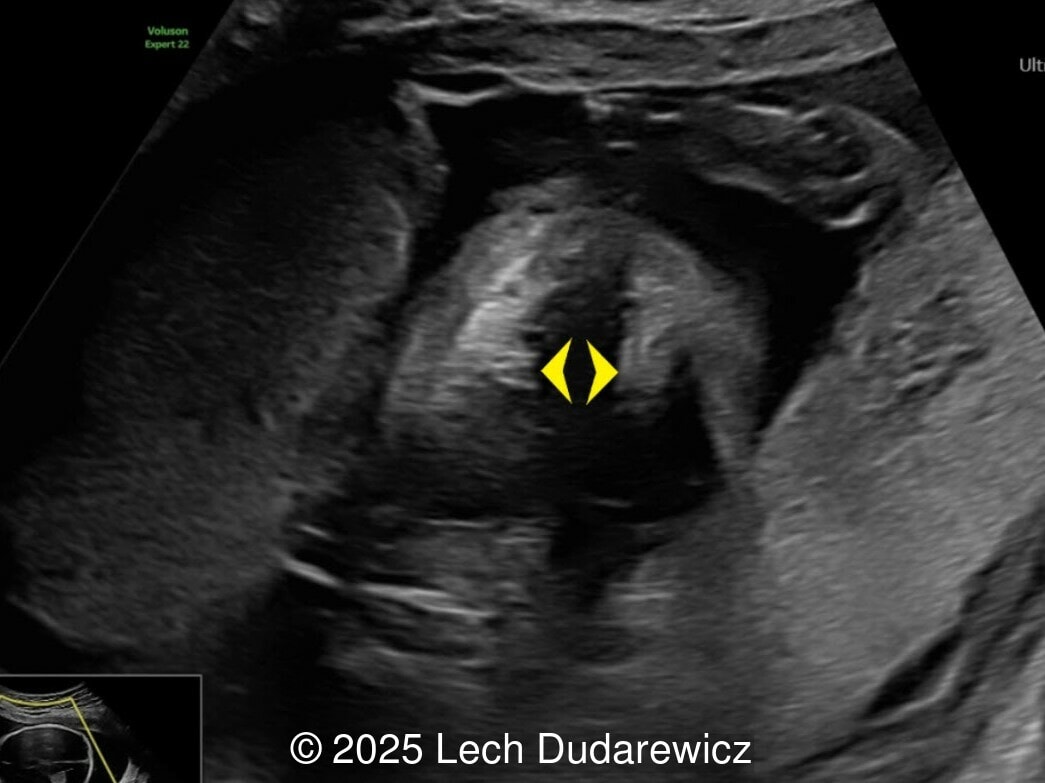 Transverse image at the top of the fetal head demonstrating marked widened frontal sutures 