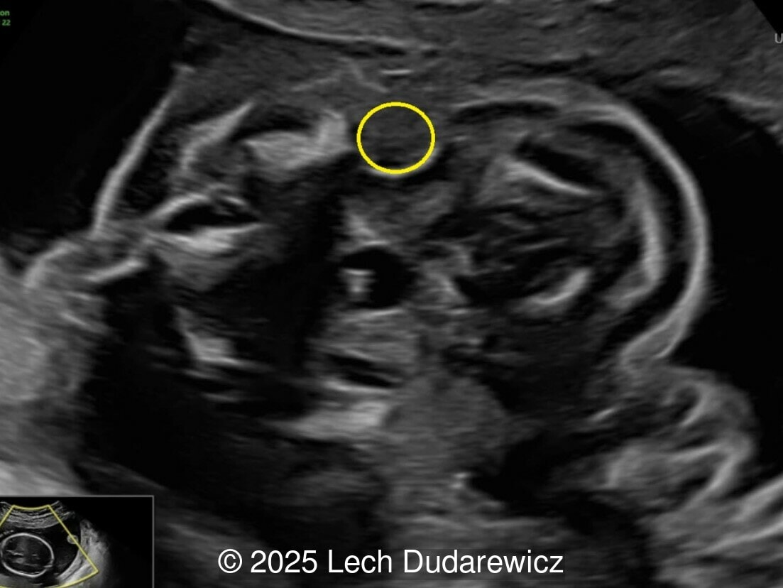 Normal tympanic cavity