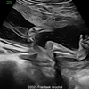 Amniotic band syndrome