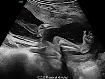 Amniotic band syndrome