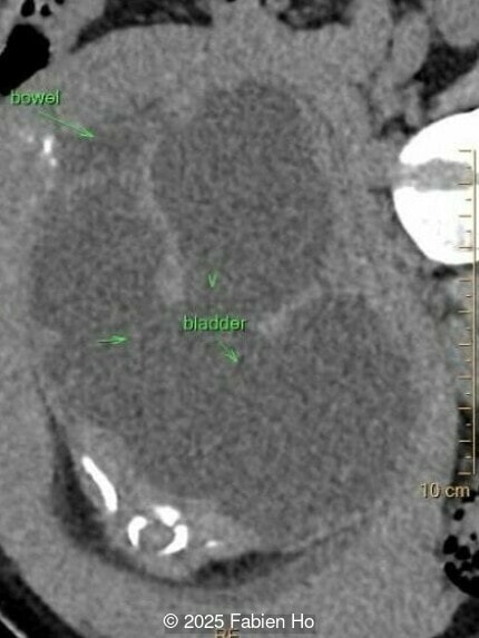 Axial image of the fetal pelvis