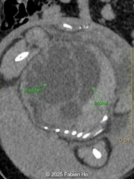 Sagittal image of the left fetal flank