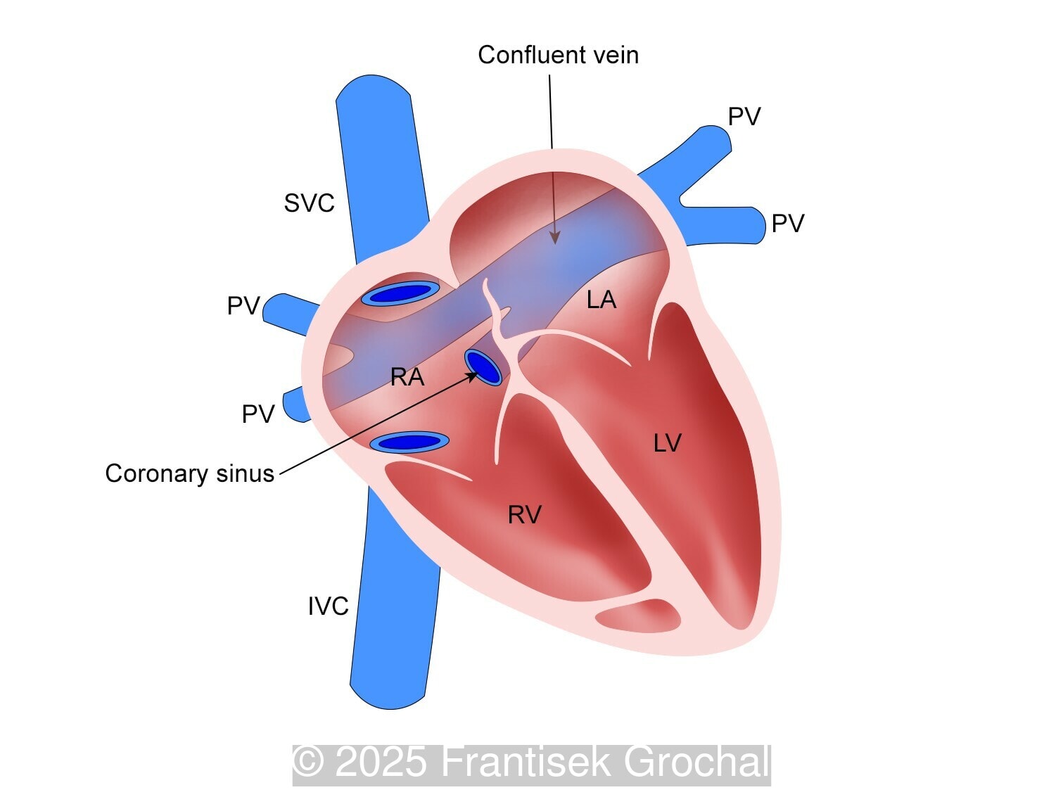 Diagram demonstrating total anomalous pulmonary venous return, Type II (Cardiac)
