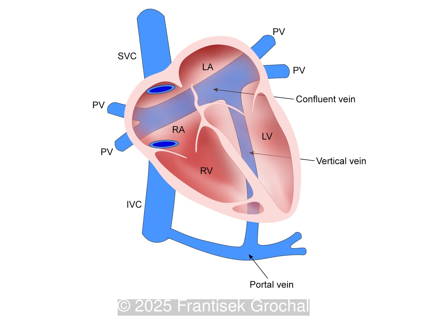 Diagram demonstrating total anomalous pulmonary venous return, Type III (Infracardiac)