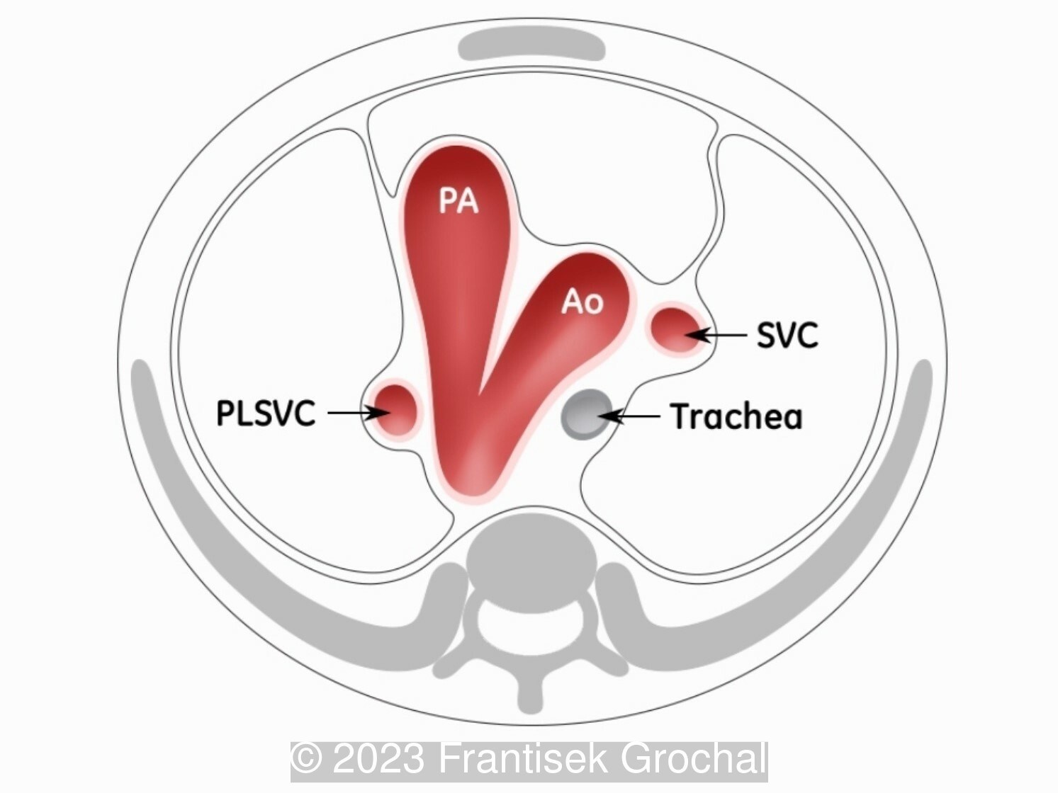 Schematic drawing of a persistent left superior vena cava (bilateral superior vena cava).