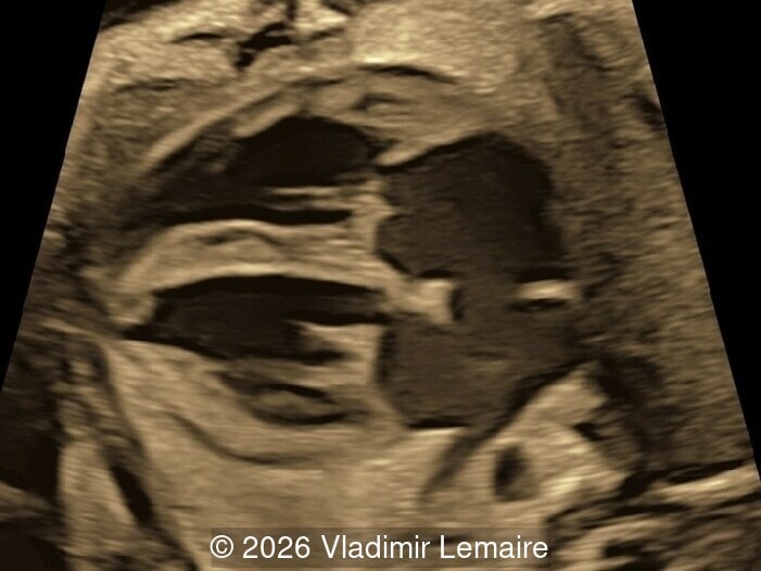Axial plane of the fetal chest at the level of the four-chamber view. 