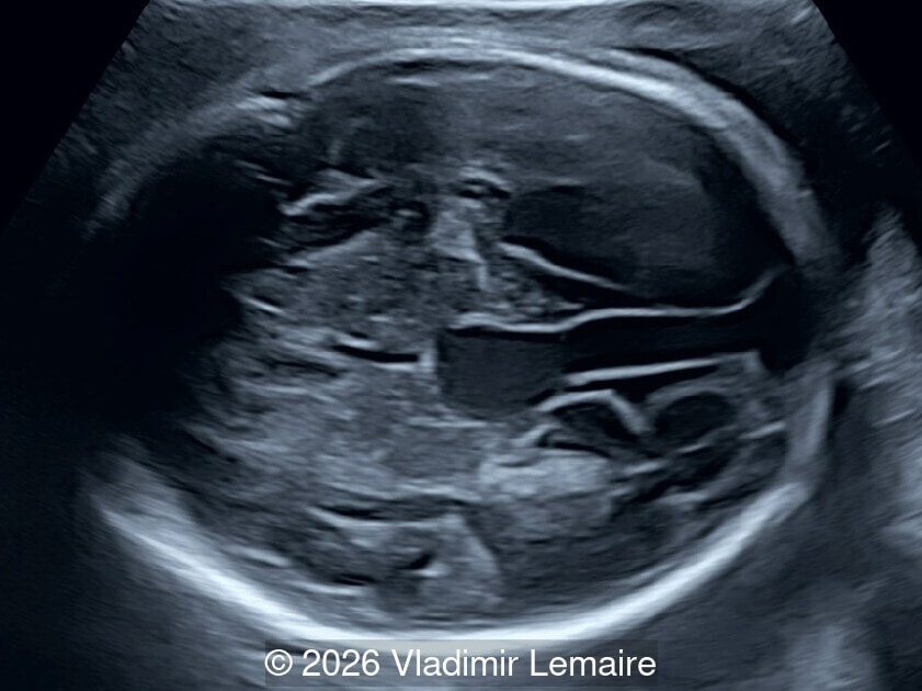 Axial image of the fetal head
