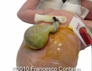 Omphalocele_Contarin_5