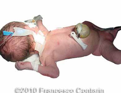 Omphalocele_Contarin_6