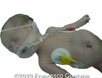 Omphalocele_Contarin_7