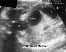 Ovarian cysts image