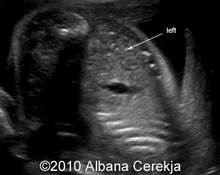 Pelvic kidney, 3 cases image