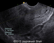 Ectopic pregnancy, twin, cervical image