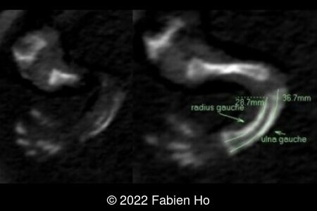 Left radius and ulna