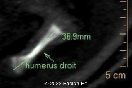 Right humerus