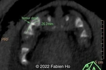 Right femur