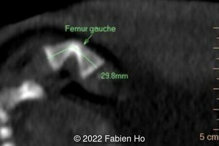 Left femur