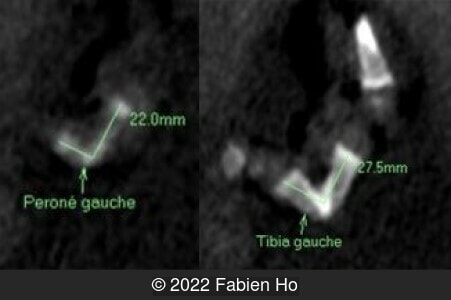 Left tibia and fibula