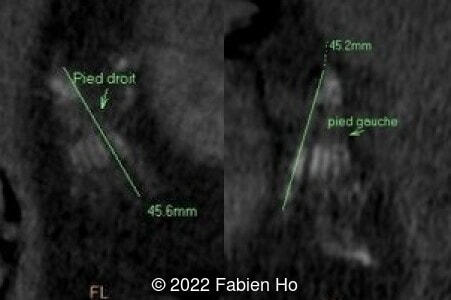 Right and left foot
