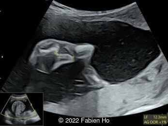 Femur length 12.3mm (<1%)
