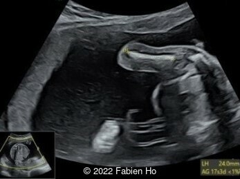 Humerus length 24mm with an estimated gestational age of 17 weeks, 3 days (<1%)