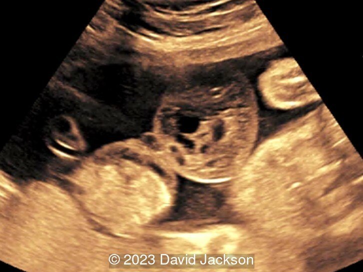 28 weeks gestation