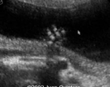 Postaxial polydactyly image