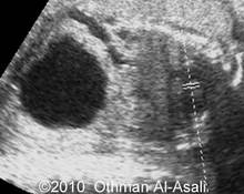 Posterior urethral valve syndrome image