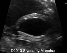 Posterior urethral valve with bladder rupture and urinary ascites image