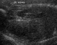 Posterior urethral valves, 22 weeks image