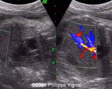 Intra-abdominal umbilical vein varix image