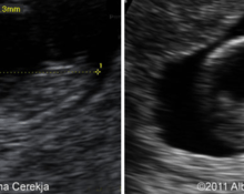 Triploidy with hydrocephaly, first trimester image