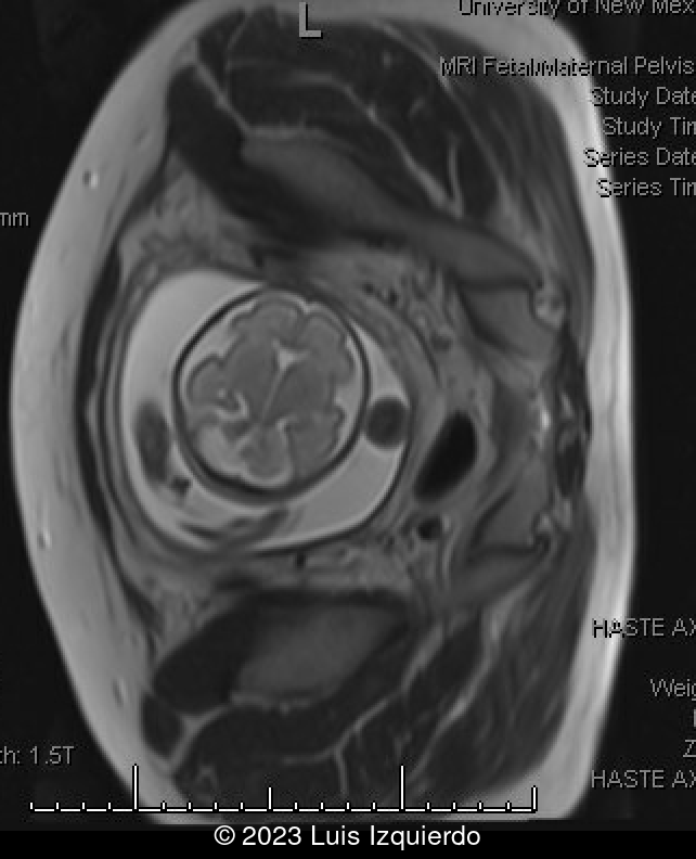 Fetal MRI