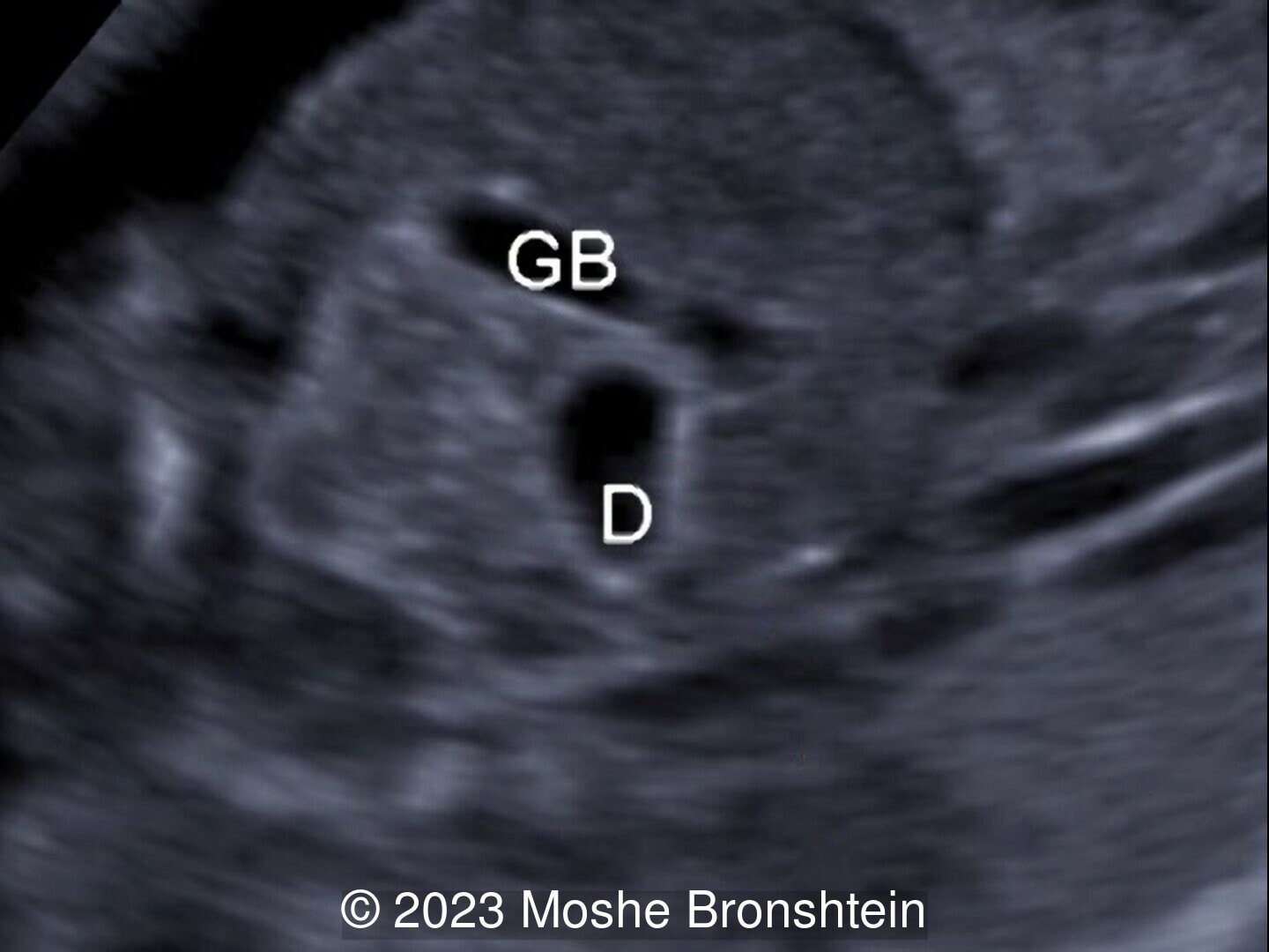 GB: gallbladder, D: duodenum