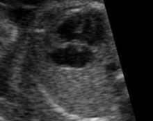 Twin pregnancy with trisomy 21 image
