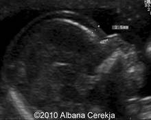 Trisomy 21 with hydrops image