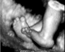 Trisomy 18, 3D, rocker-bottom foot image