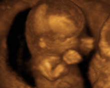 Trisomy 21, 13 weeks image