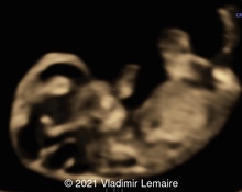 Brain Vesicles: Normal Appearance at Nine Weeks of Gestation image